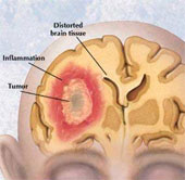 Develop new technology for early detection of brain tumors
