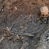 Diagnosis for King Richard III