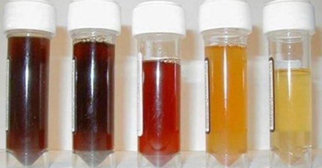 Diagnosis of the disease through urine