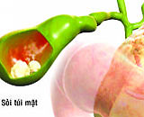 Diet for people with gallstones