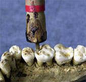 Discover dental techniques in ancient times