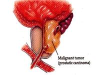Discover the unique genome that causes prostate cancer