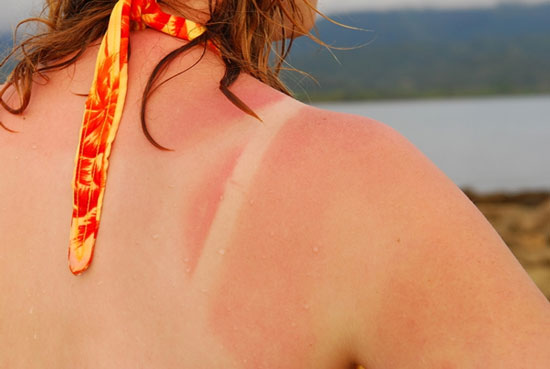 Discover two new gene variants that cause malignant skin cancer
