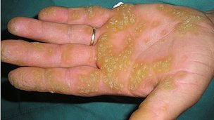 Discovered genes that cause skin spots