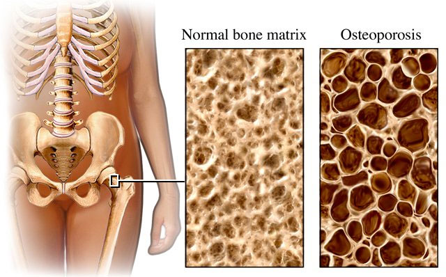 Discovered many new genes related to osteoporosis