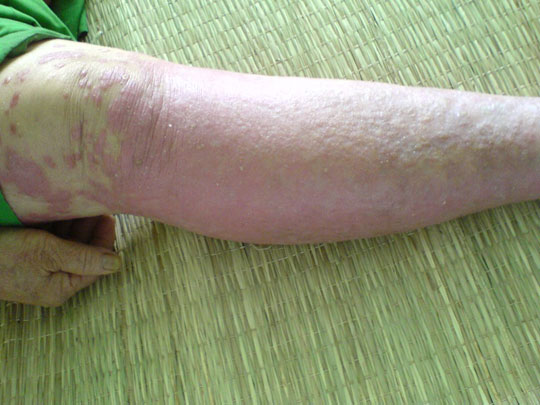 Discovered six new genes causing psoriasis