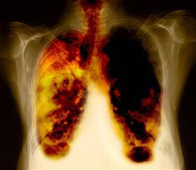 Discovered three new genes that cause lung cancer