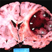 Discovered two proteins that cause brain cancer