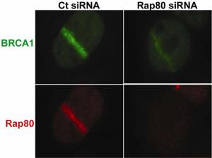 Discovering new genes can cause breast cancer