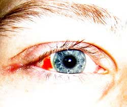 Diseases of the eye