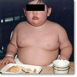 Doctors do not correctly diagnose overweight in children