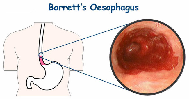 Drinking too hot over 65 degrees C can cause esophageal cancer