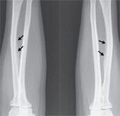 Drinking too much tea causes calcified bones