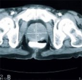 Early detection of blood cancer cells by sound