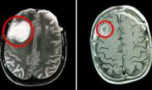 Early detection of brain tumors in children