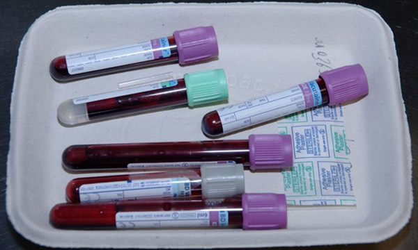 Early detection of ovarian cancer thanks to regular blood tests