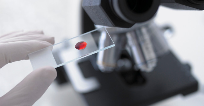 Early diagnosis of pancreatic cancer with a drop of blood