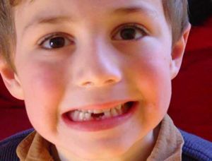 Early loss of teeth affects children's oral health
