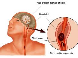 Early magnetic resonance imaging will help save stroke patients