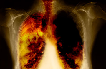 Early screening for lung cancer
