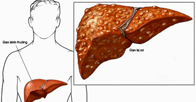 Early signs of cirrhosis