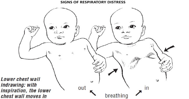 Early signs of pneumonia in children during the cold season