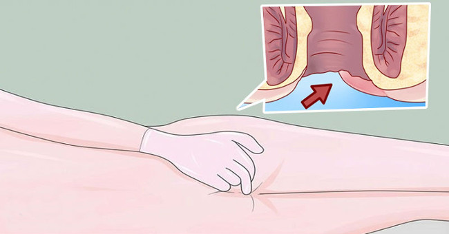 Early signs warn you about anal cancer
