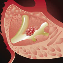 Eating a lot of sugar is more susceptible to pancreatic cancer