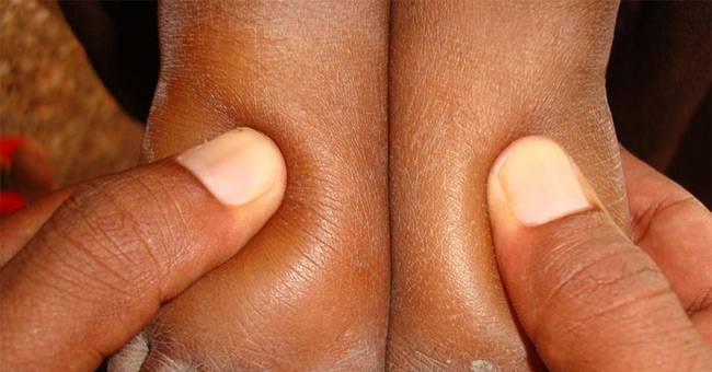 Edema - a sign of many dangerous diseases