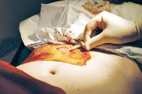 Effect of treatment against heroin relapse with Abernil