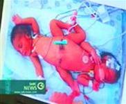 Egypt: successful surgery first conjoined twins