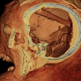 Egyptian mummies forgot the tools in the dead man's brain