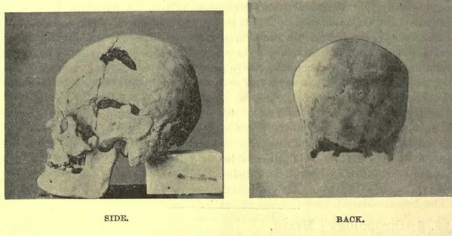 Egyptian Pharaoh was the first to suffer from a giant disease