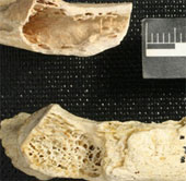 Evidence of cancer in Neanderthals