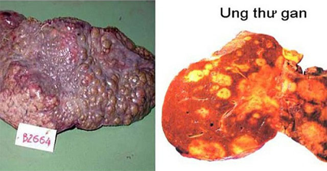 Experts explain why cancer is soaring to the top