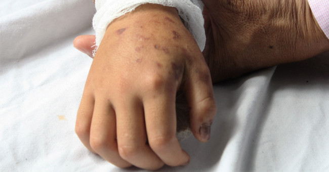 Experts point out 5 mistakes when first aid for bitten by poisonous snakes