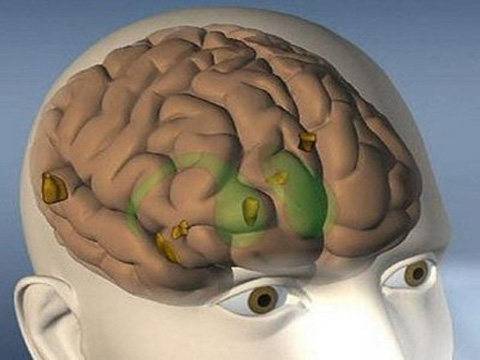 Exposure to pesticides is prone to Parkinson's disease