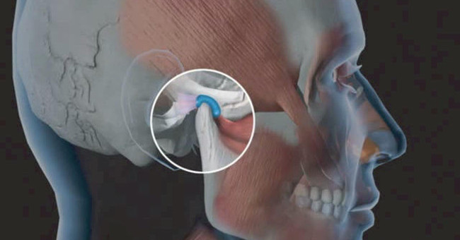 Expression and treatment of temporomandibular dysfunction