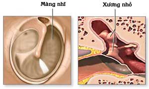 Expression of eardrum perforation