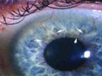 Eye complications due to the use of contact lenses