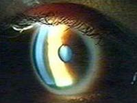 Eye tests can detect Alzheimer's disease