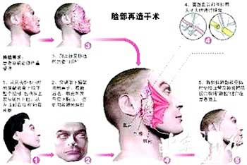 Face transplant experience from China