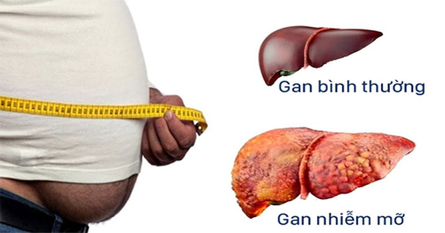Fatty liver: Causes, symptoms and treatments