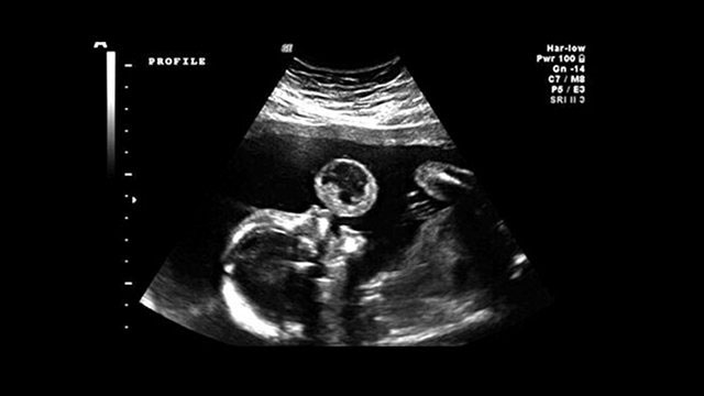 Fetal tumorectomy surgery