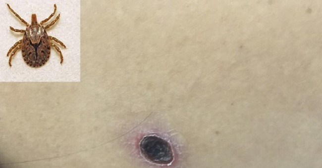 Fever is difficult to detect, can lead to death