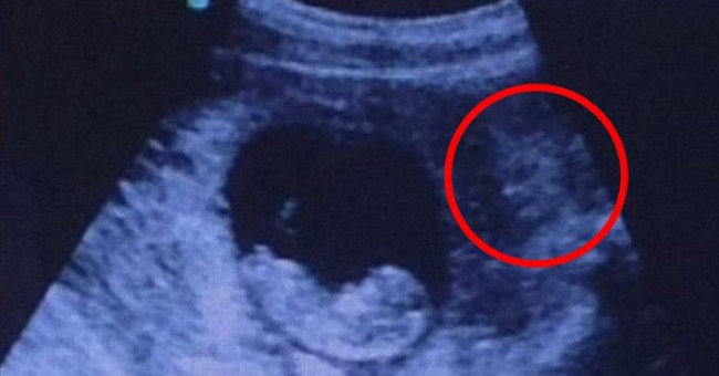 Fever with a surreal ultrasound