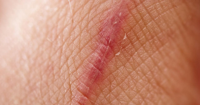 Finally science also found a way to heal without leaving a scar