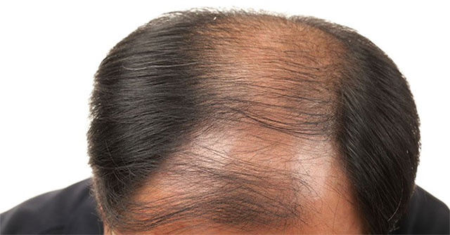 Find a way to use scent to treat baldness