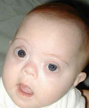 Find medicines to treat Down syndrome