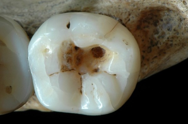 Find out how to cure the teeth of the ancient people